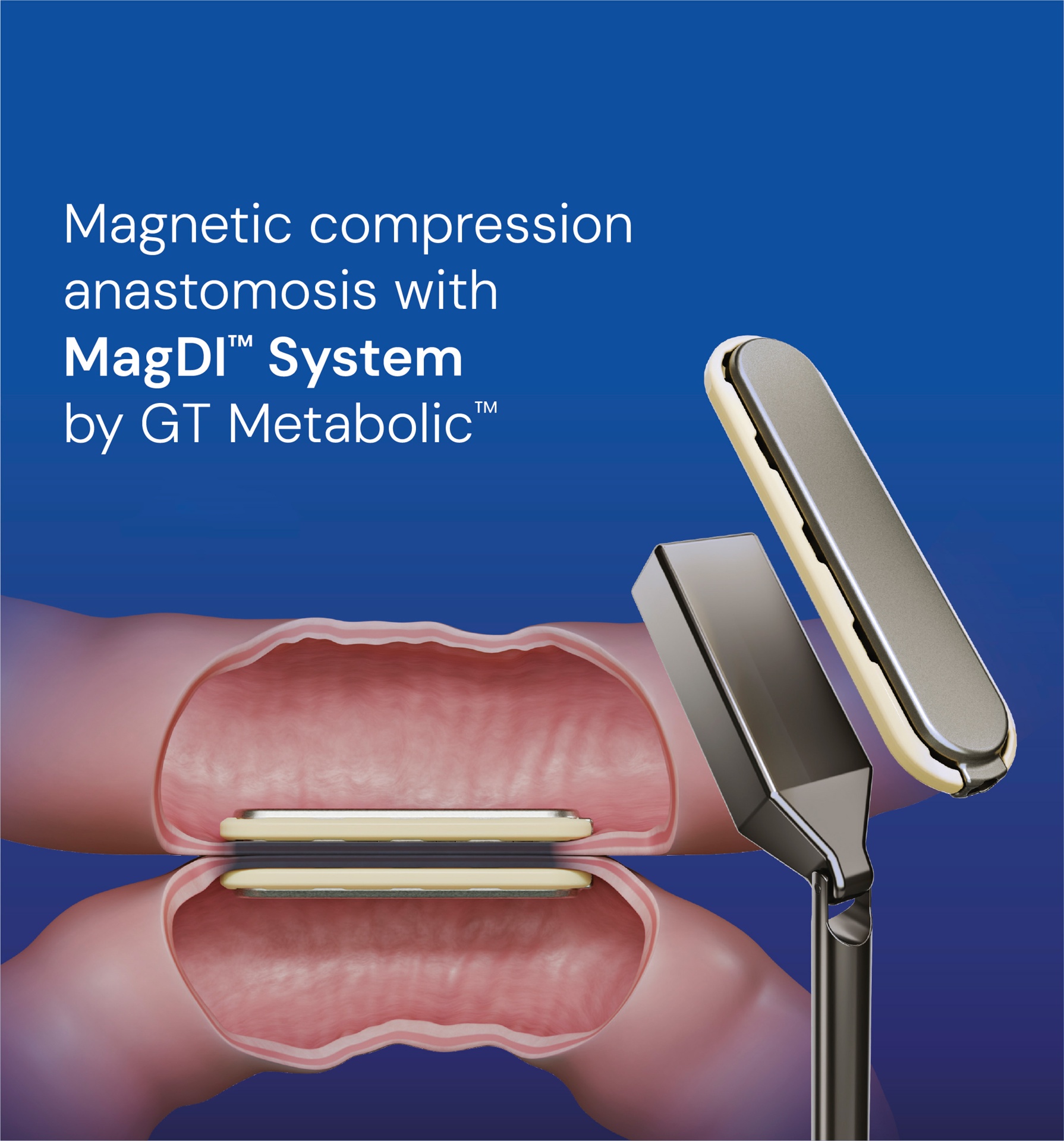 Dispositivo de anastomosis por compresión magnética